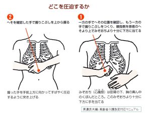 腹部突き上げ法